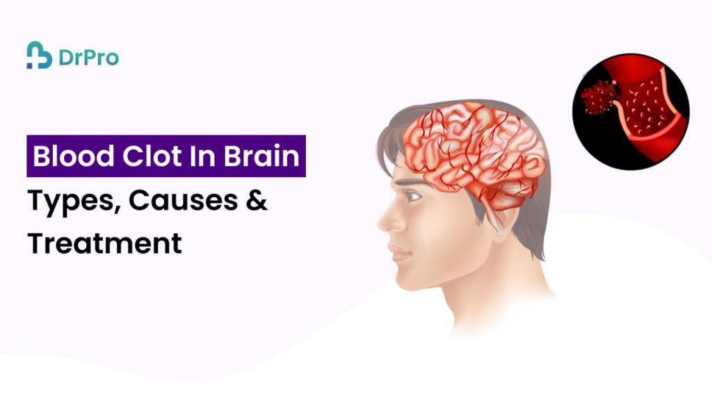 Blood Clot in the Brain: Types, Causes and Treatment